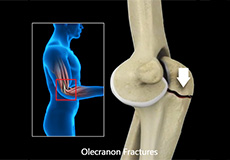 Elbow Fracture