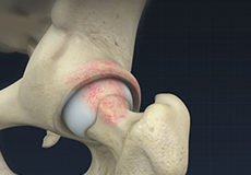 Femoral Osteoplasty
