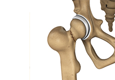 Hip Fracture Care 