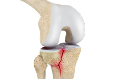 Knee Fracture Care