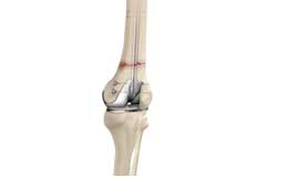 Periprosthetic Knee Fracture Fixation