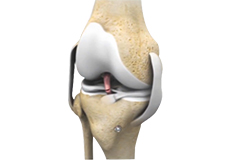 Revision Knee Ligament Reconstruction