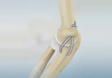Tommy John UCL Reconstruction